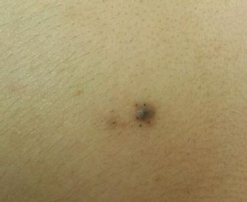 黑痣癌變