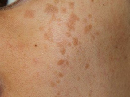 男人臉上長斑的