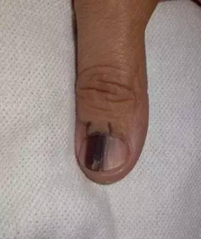 手指甲上有豎紋圖解 (51) 