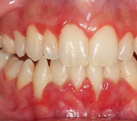 牙齦炎和牙周炎