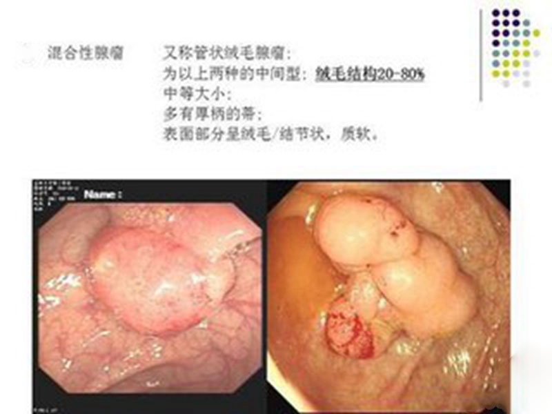 直腸腸腫瘤術後