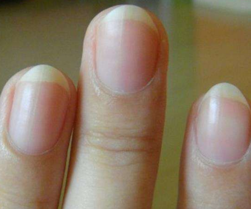貧血指甲