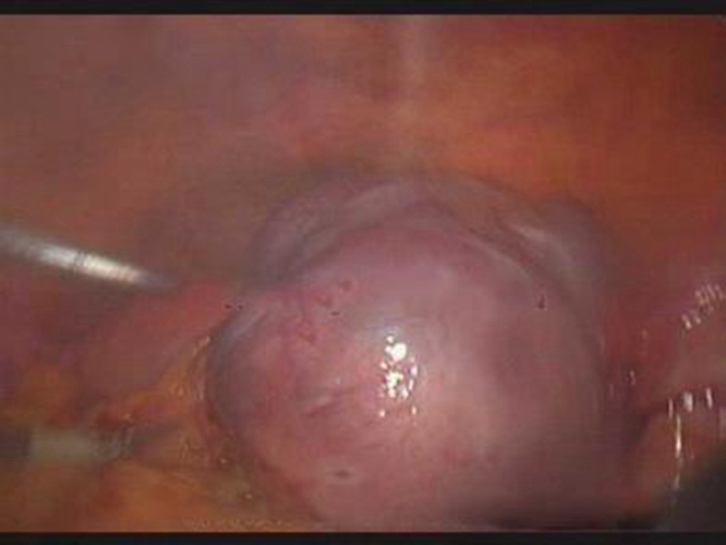 右側附件巧克力囊腫的症狀