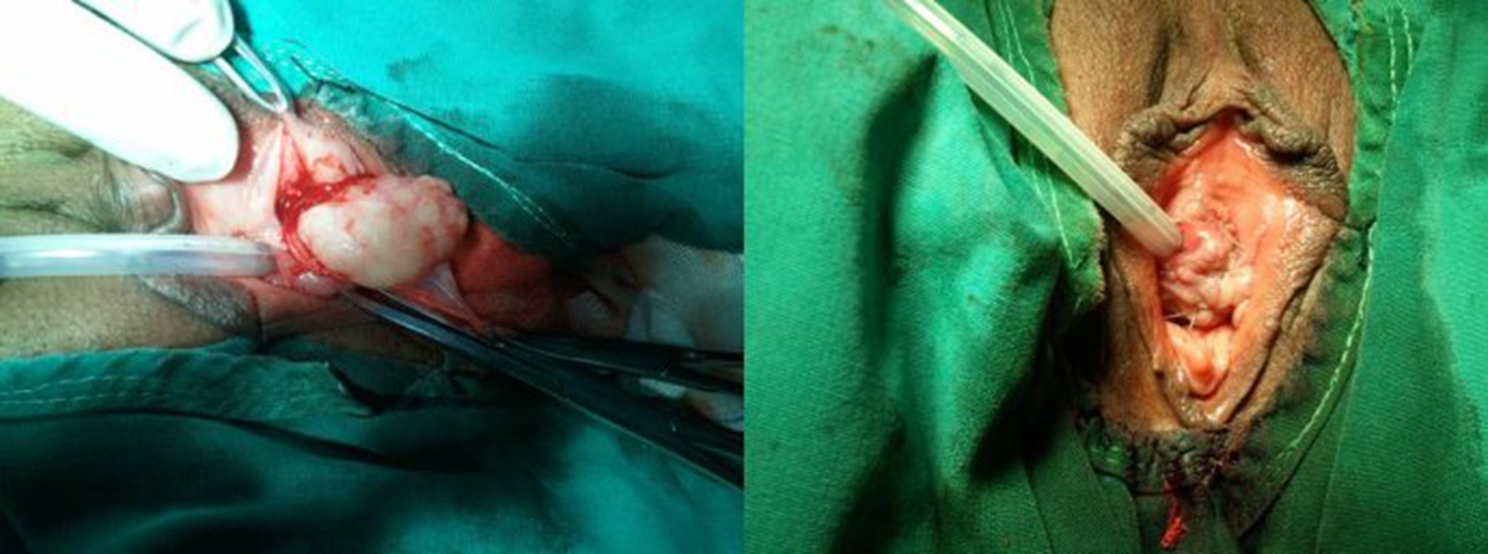 女性尿路感染尿引起道腫瘤