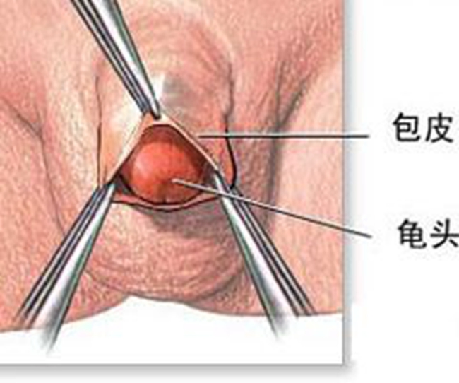 嵌頓包莖水腫 