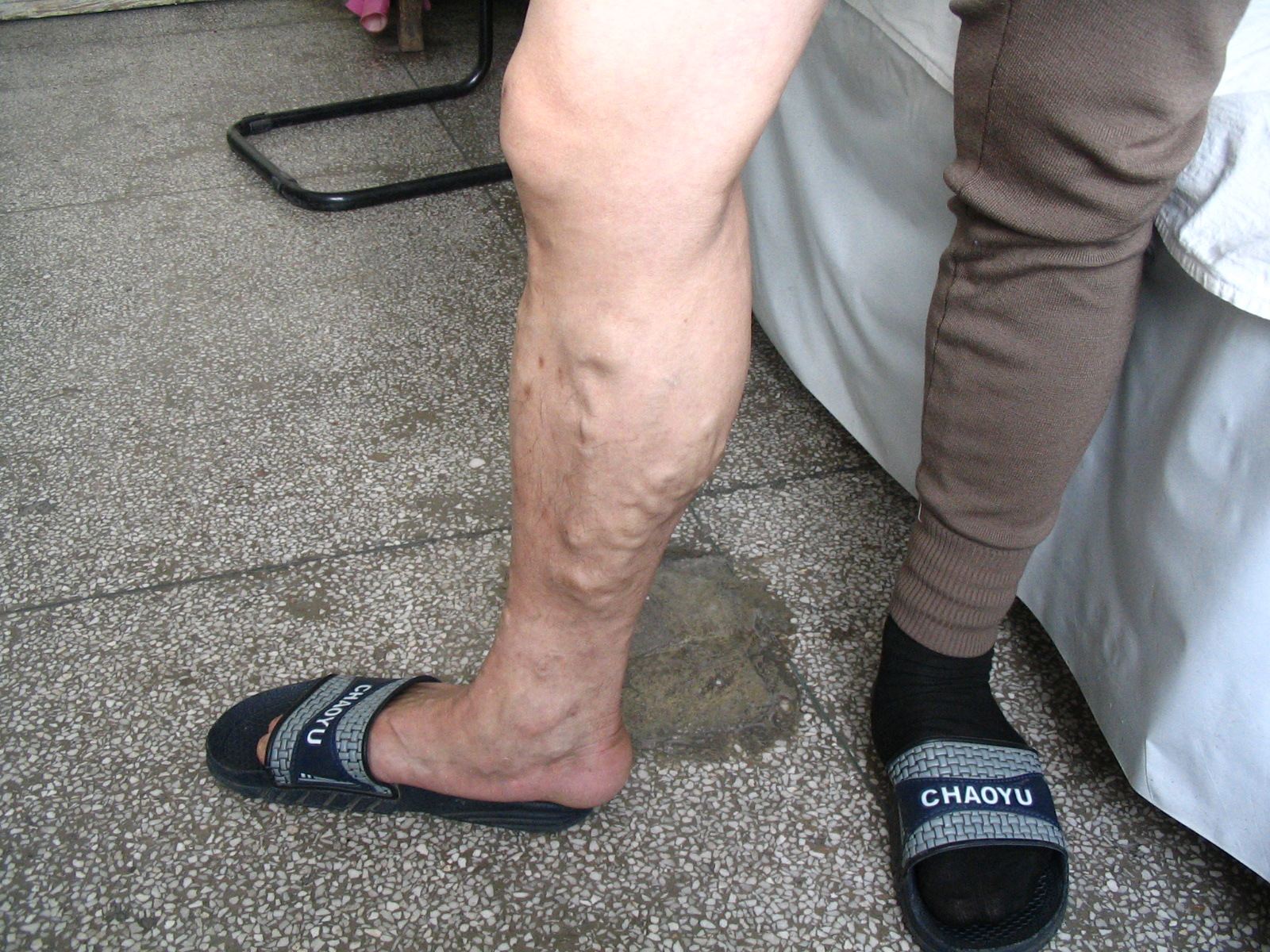 血栓性靜脈炎高清