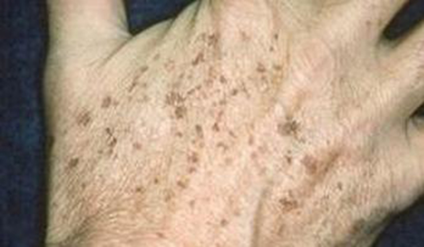 手背上的老年斑