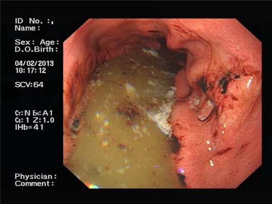 食道炎症狀 (33) 