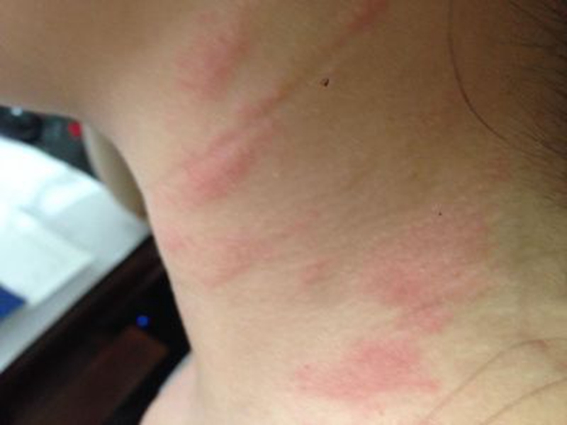 頸部日光性皮炎