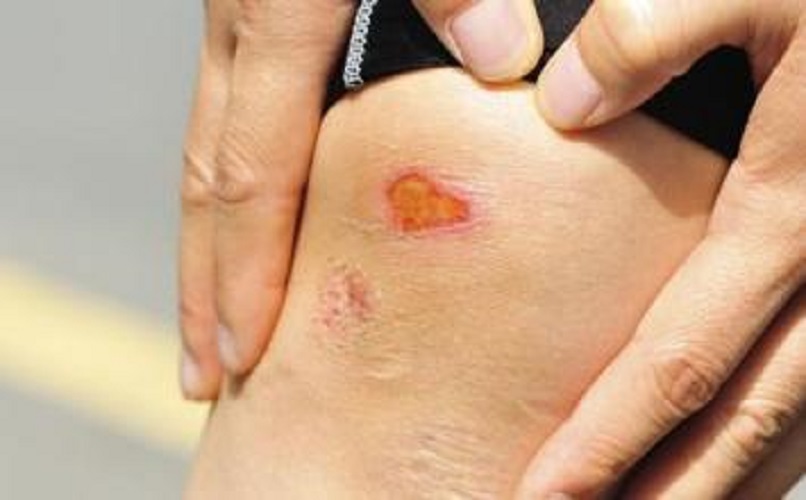 膝蓋部破傷風傷口