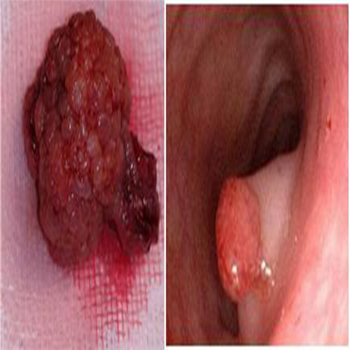 直腸息肉糜爛的