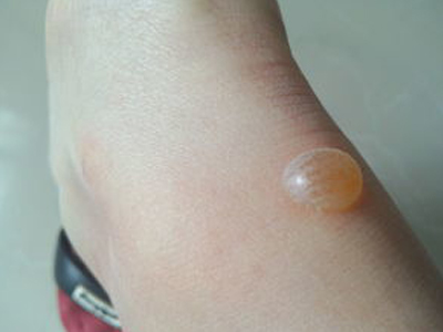 被跳蚤咬的症狀