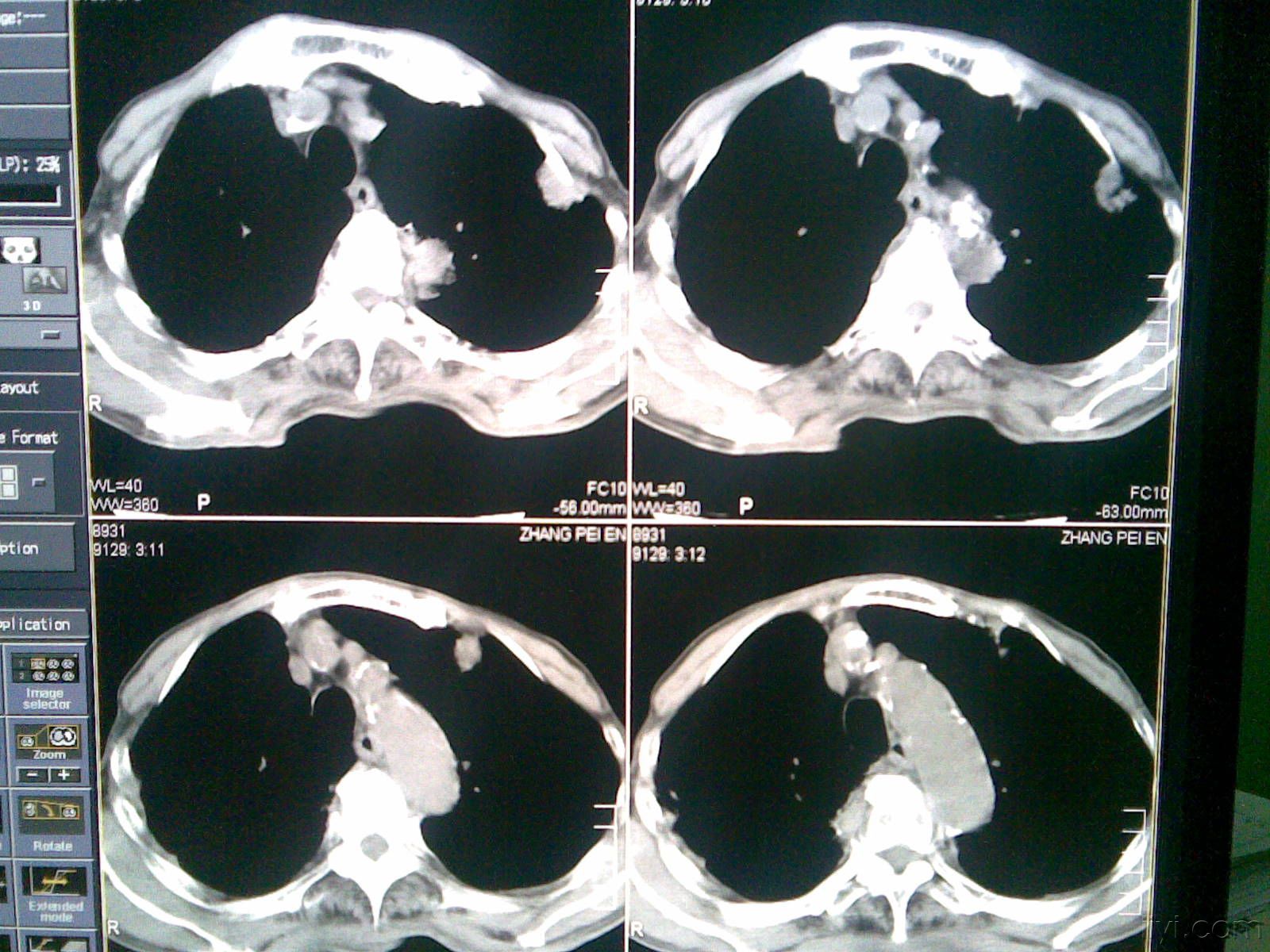 ＿右肺纖維化CT檢查