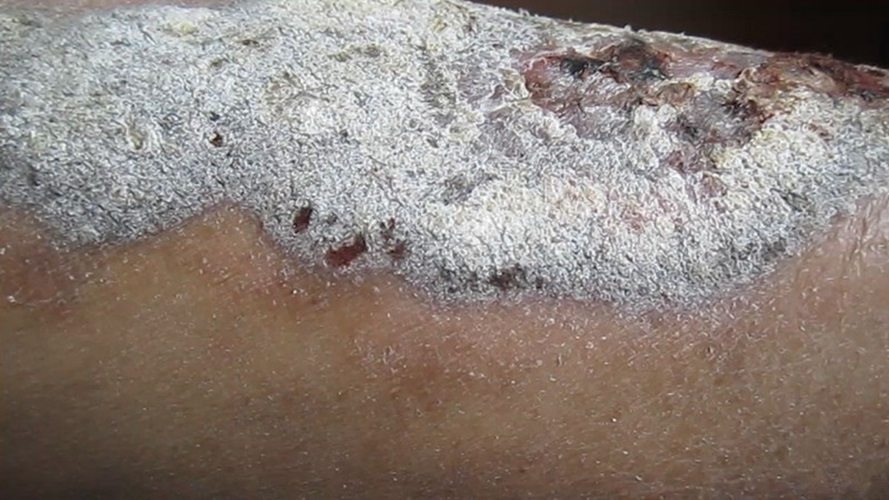 胸腺皮膚腫瘤術後下肢皮膚病變 