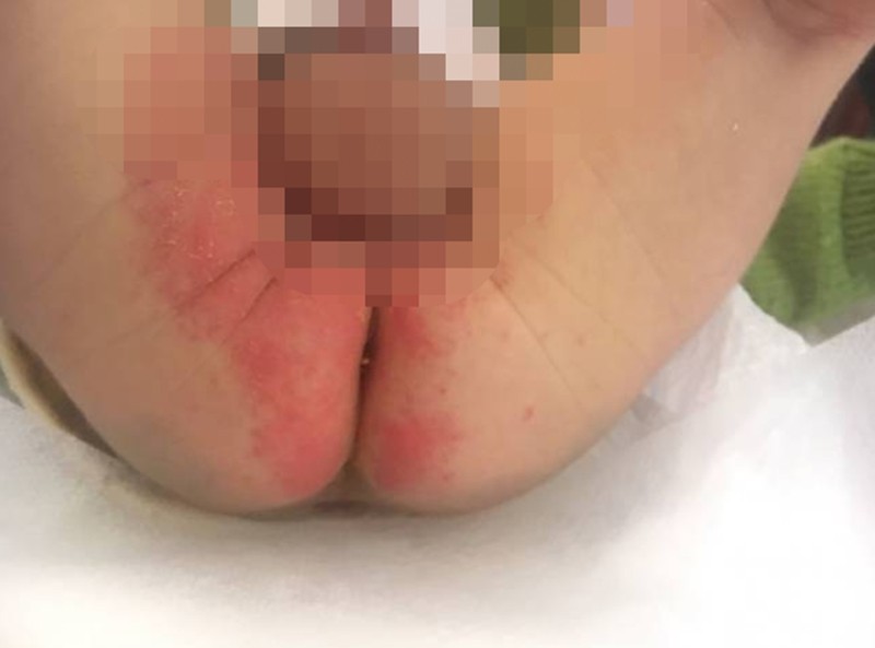 肛周溼疹的擴散