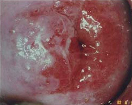 淋病的症狀 (43) 