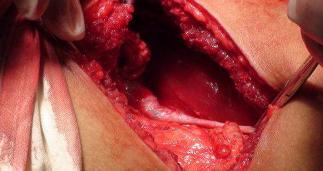 腎結石開刀手術