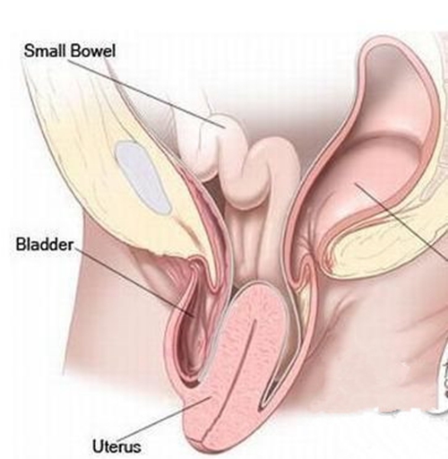 子宮脫垂會導致病變的