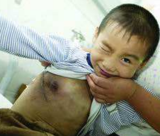 淺表淋巴癌早期症狀