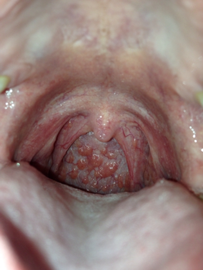喉部淋巴濾泡增生 (6) 