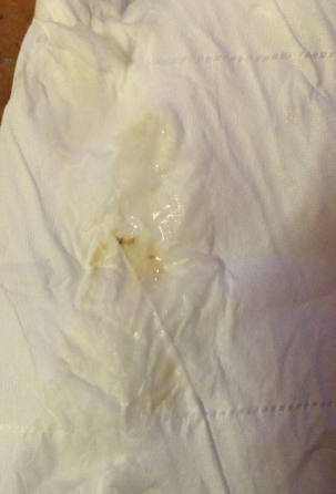 白帶帶有褐色分泌物 (61) 