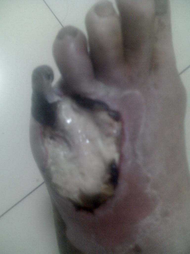 需要裁足的糖尿病足