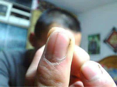 手指甲上有豎紋圖解 (4) 