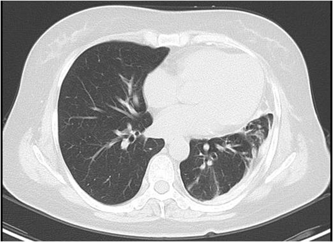 左肺腺癌術後胸腔內