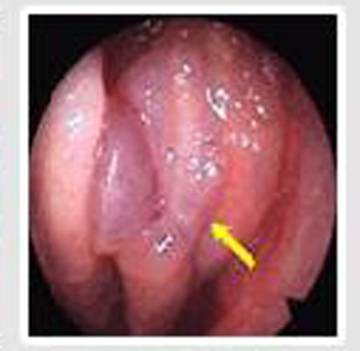 右鼻腔的慢性鼻炎