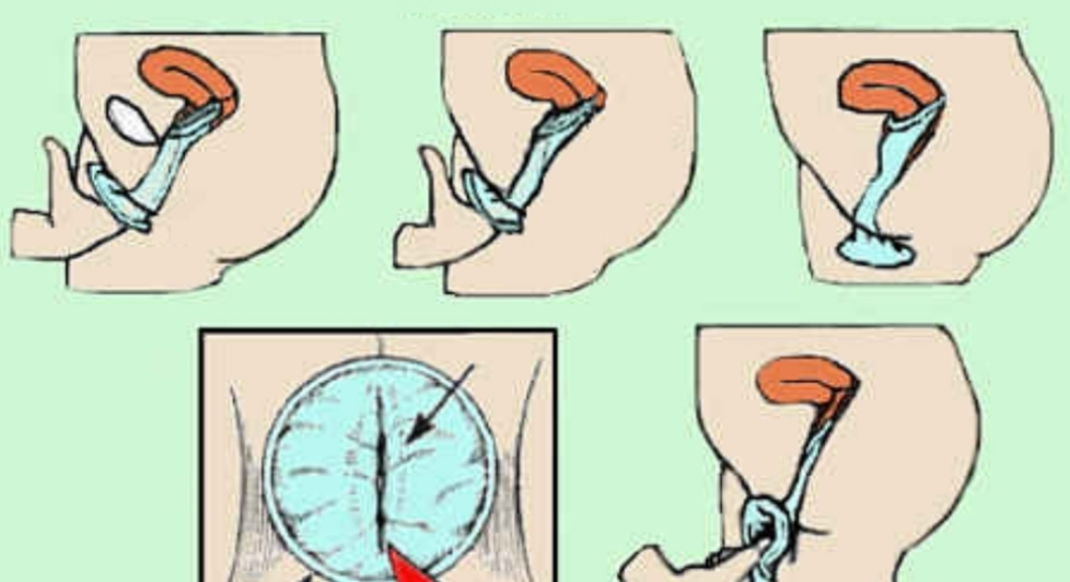 正常的人工陰道的