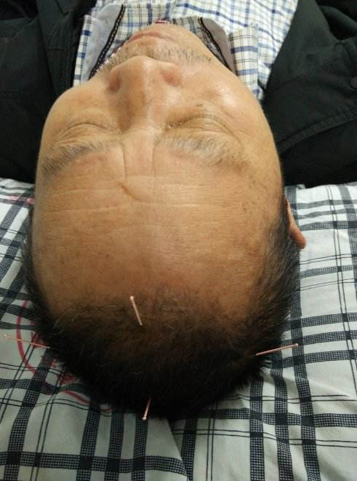 針灸治療腦血管痙攣