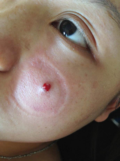 血熱的症狀痘痘