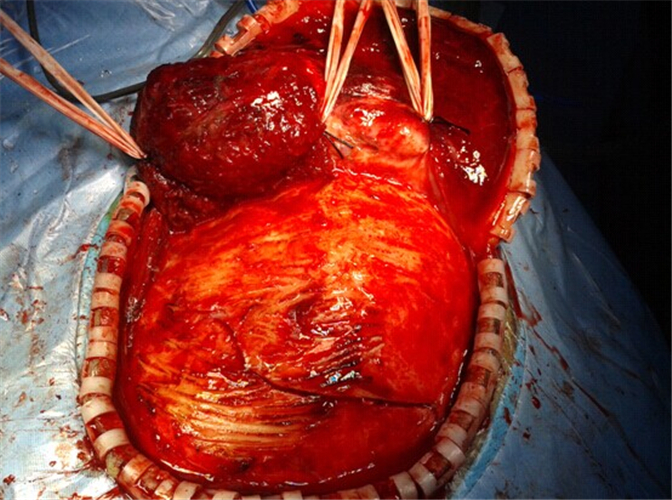 手術中發生腦疝