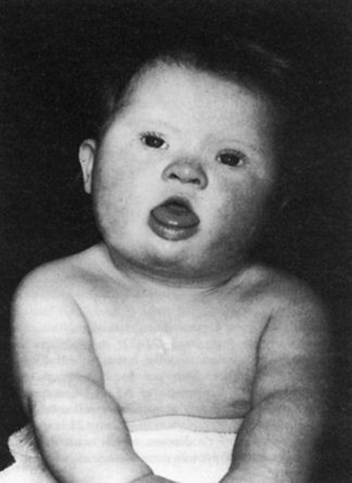 新生兒唐氏綜合症的面容