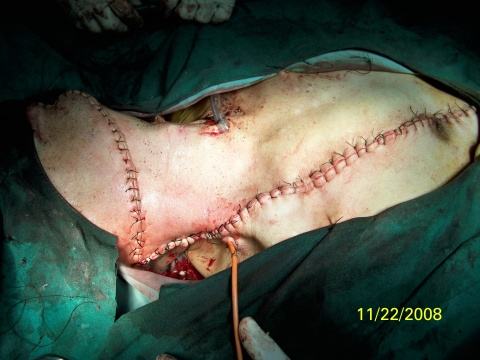 扁桃體癌圖  (67) 