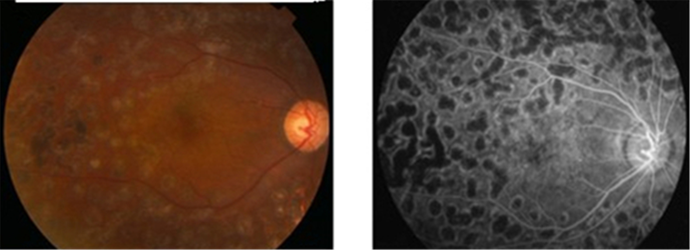 血管膜視網膜脫落
