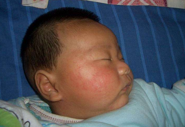 臉上皮膚過敏症狀