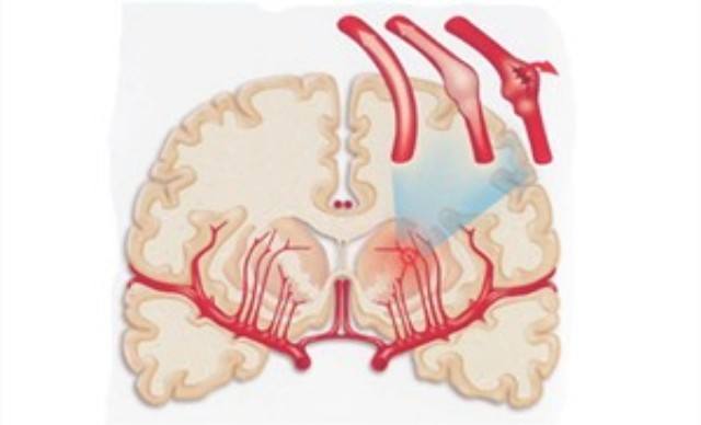腦血管痙攣漫畫 