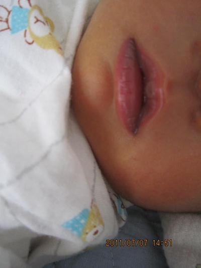 新生兒嘴唇發紫 (45) 
