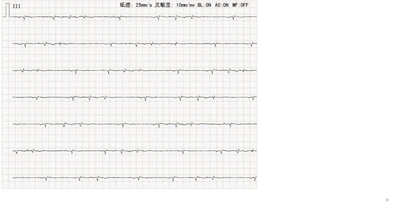 頻發房性早搏 (46) 