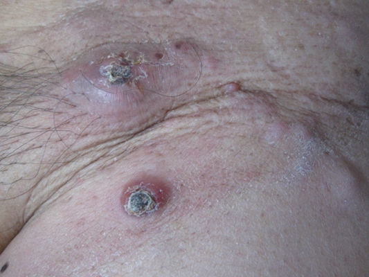 黴菌性龜頭炎 (48) 