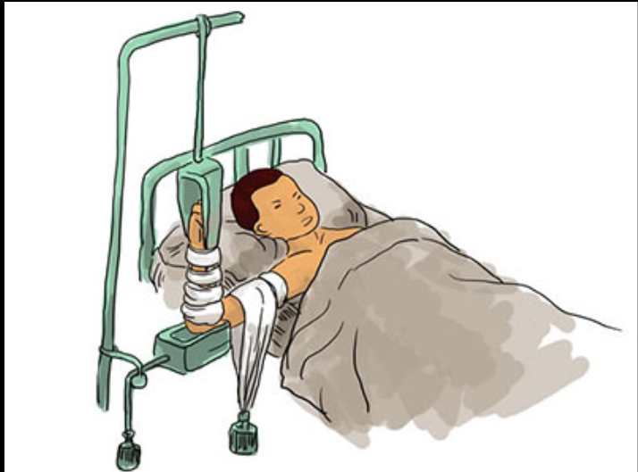 肋骨骨折的包紮 