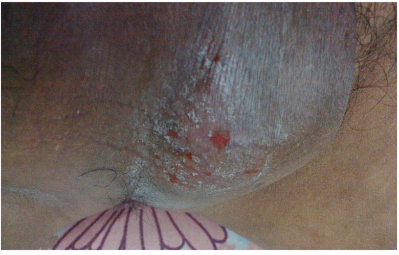 男人外陰瘙癢的症狀