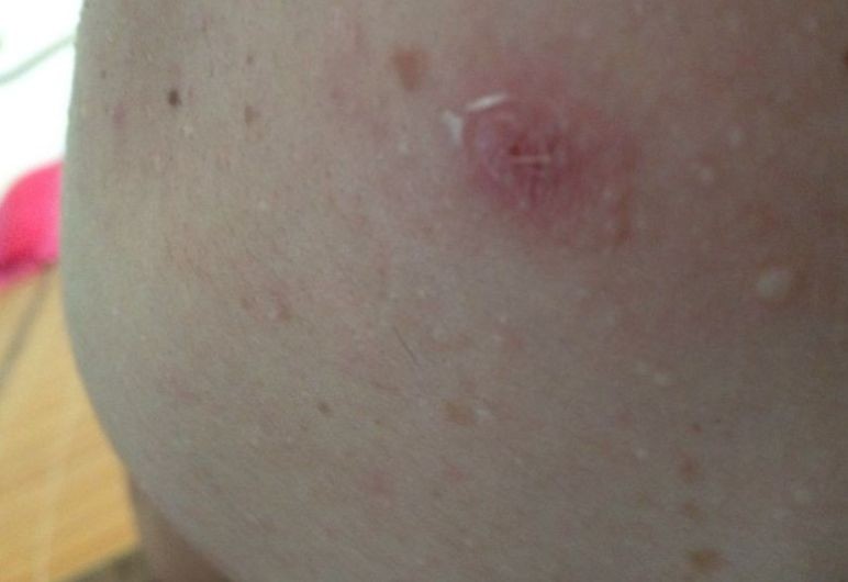 臀部癤子的症狀