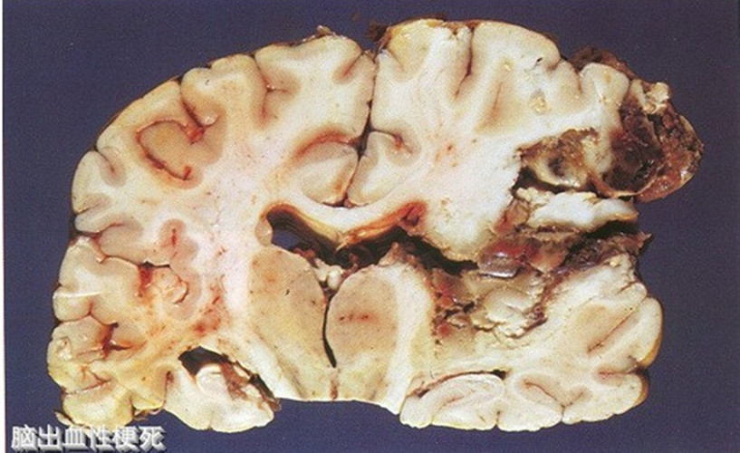 腦出血性梗死冠狀切片