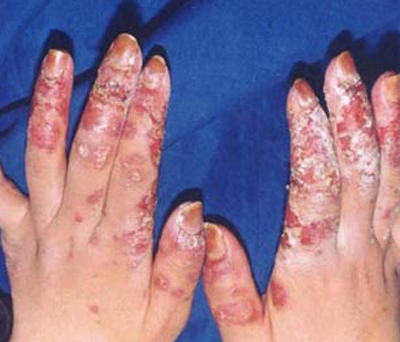 系統性紅斑狼瘡診斷標準 (39) 