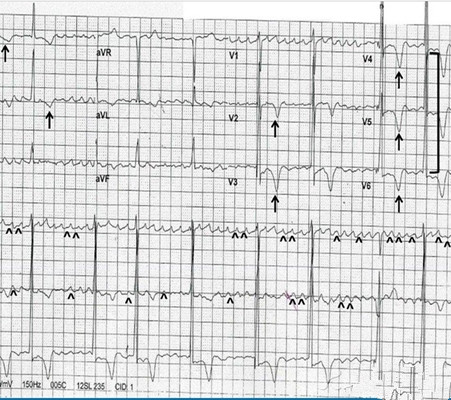預激綜合徵心電圖 (85) 