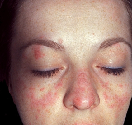 激素臉排毒症狀 (56) 