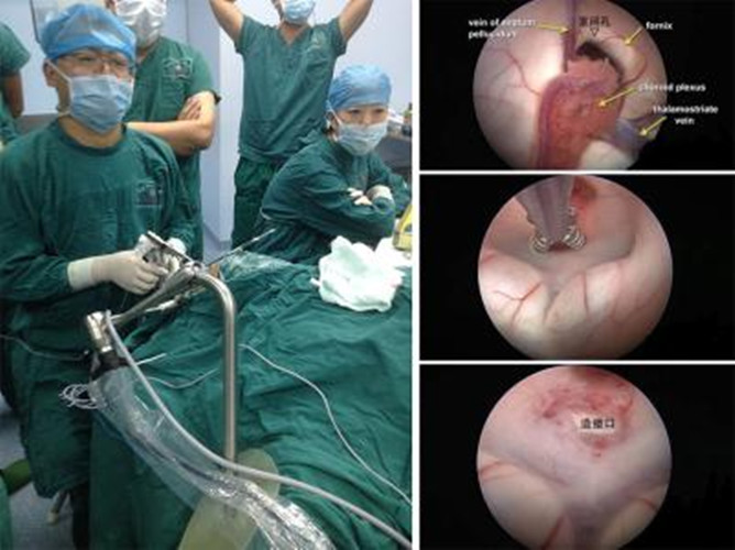 腦出血微創手術