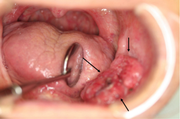 舌癌的初早期症狀